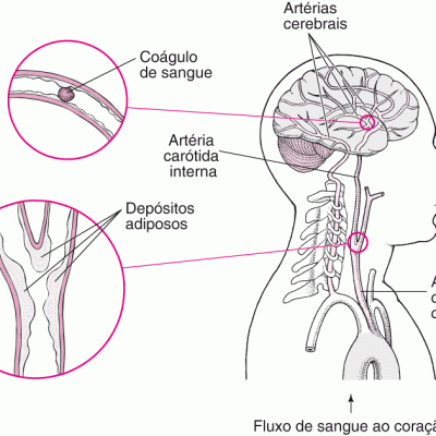 NEU_clots_clogs_stroke_pt