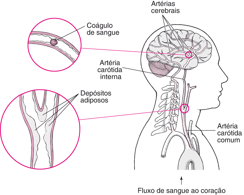 NEU_clots_clogs_stroke_pt